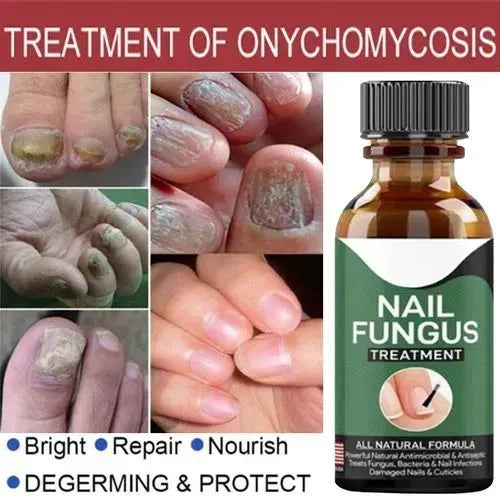 Nail Fungus Treatment Serum 10ml